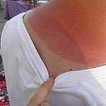 Leo wieder einmal verbrannt